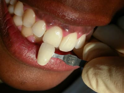 Après2appli g6ngks - Eugenol