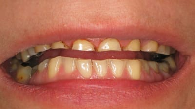 Avant usure  kttbnd - Eugenol