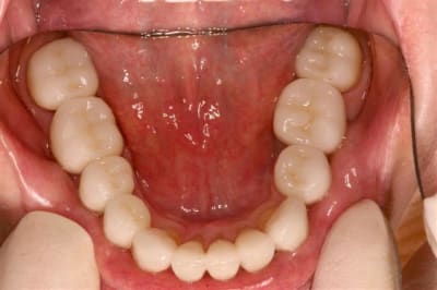 Bas  3 ans post op  paxc4q - Eugenol