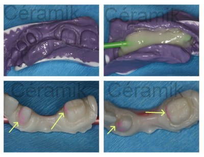 Bridge q3 qlz0cn - Eugenol