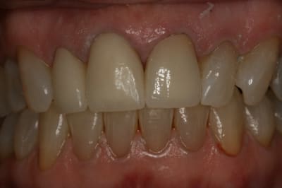 Couronnes ips empress 21 11 12 bdkmoq - Eugenol