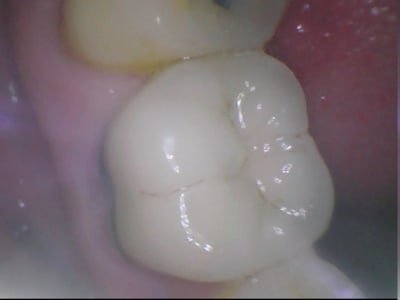 Cam buccale pa5nzf - Eugenol