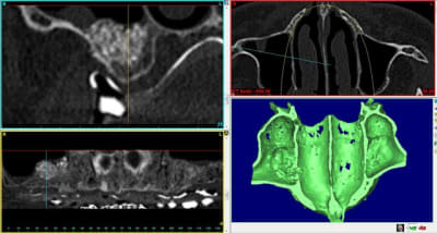 Capture apr s sinus lift droit jkcxdr - Eugenol