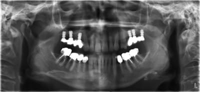 Certes maxillaire jpt2wk - Eugenol