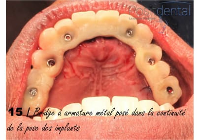 Chirurgie guidée   mise en charge immédiate 015 aeaui5 - Eugenol