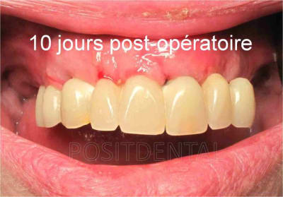 Cicatrisation gingivale mise en charge imm diate 10 j post op fevxag - Eugenol