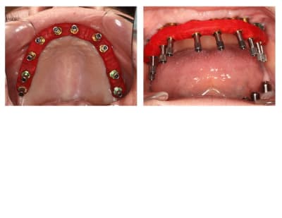 Cl e duralay  10 implants  idlax9 - Eugenol