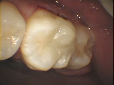 Coiffage pulpaire - Eugenol