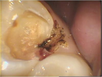 Coiffage pulpaire - Eugenol