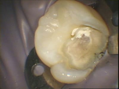 Coiffage pulpaire - Eugenol