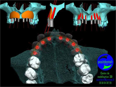Comment simplifier et fiabiliser les greffes cas clinique dr pxav 1 to7kuq - Eugenol