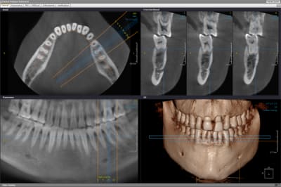 Conebeamct xray2 rg1mng - Eugenol