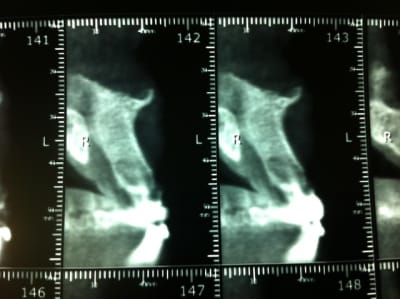 Cone beam tl7mz0 - Eugenol