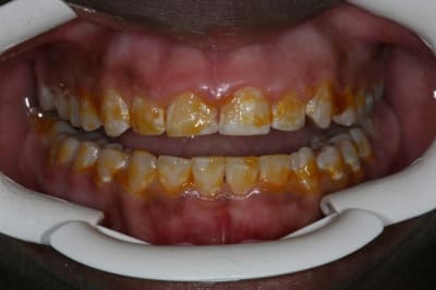 Duraphat colgate img 3 dy1bat - Eugenol
