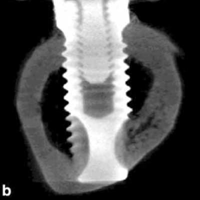 Duyck implant bicortical tibia lapin xa9lte - Eugenol