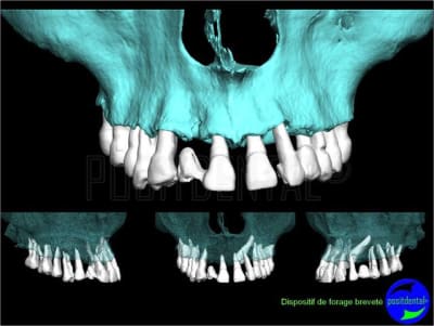 Eimci et canine incluse positdental 02 e14cgb - Eugenol