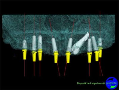 Eimci et canine incluse positdental 03 sjwhyn - Eugenol