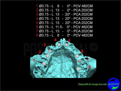 Eimci et canine incluse positdental 04 kzgpnt - Eugenol