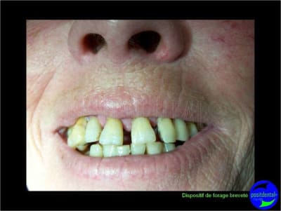 Eimci et canine incluse positdental 06 wdwwrl - Eugenol