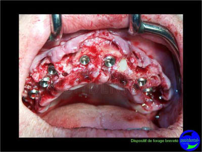 Eimci et canine incluse positdental 10 dcq4ib - Eugenol