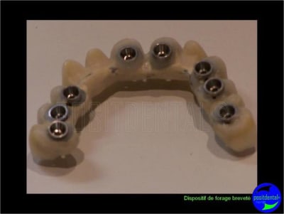 Eimci et canine incluse positdental 11 e3rgyt - Eugenol