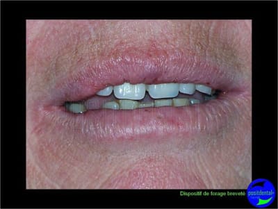 Eimci et canine incluse positdental 13 qsoxkm - Eugenol