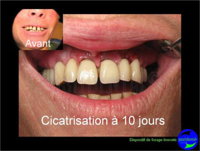 Eimci et canine incluse positdental 15 ux9iqk - Eugenol