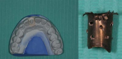 Empreinte  1 mirrlh - Eugenol