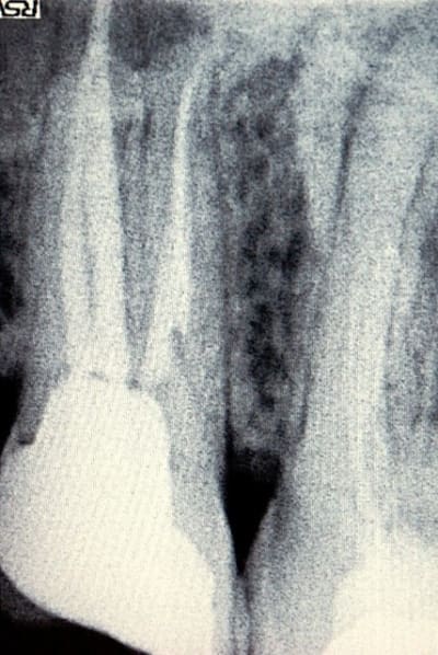 Endo17 ecmban - Eugenol