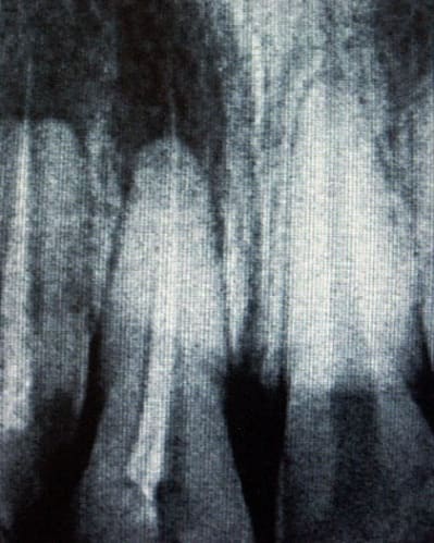 Endo1 d3nylw - Eugenol