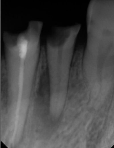 Endo bien preop pmwtkm - Eugenol