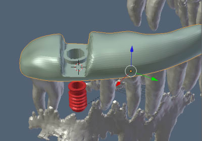 Edentulous space vgcn2t - Eugenol