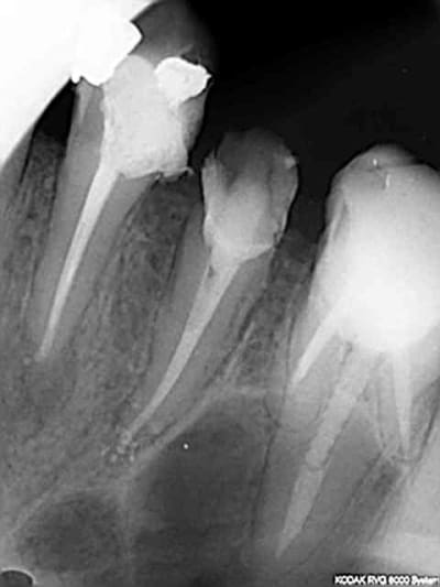 Endo2 nryenb - Eugenol