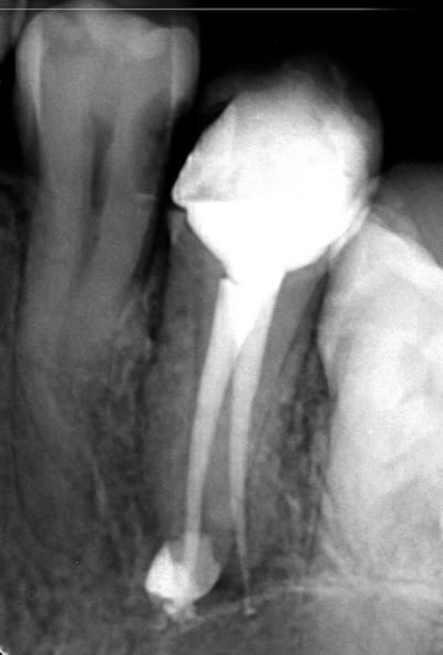 Endo 2 g96boc - Eugenol