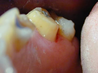 Endo sur dent taillée czvvbr - Eugenol