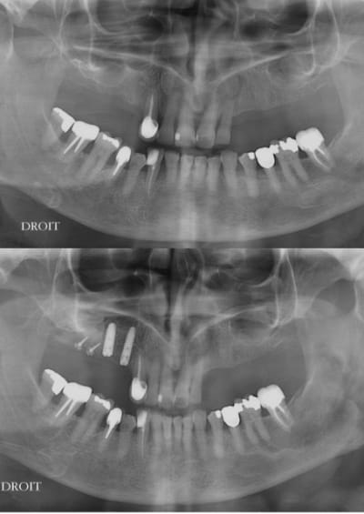 Expansion osseuse et sinus lift kqiasi - Eugenol