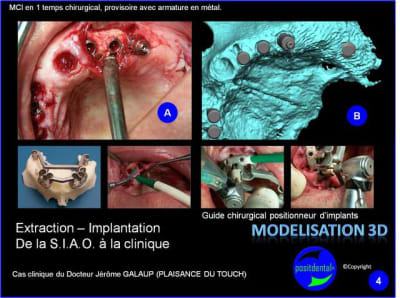 Extraction   implantation   mod lisation 3d positdental  13 xqnoqp - Eugenol