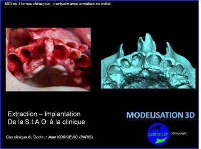 Extraction   implantation   mod lisation 3d positdental  7 gvkucu - Eugenol