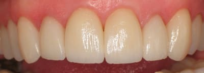 Facettes 5 ans post  op pkarof - Eugenol