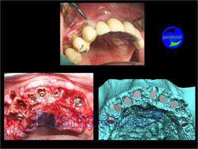Fiabilit  de la 3d en planification implantaire og6akk - Eugenol