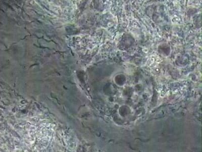 Gun avec amibes  spirochètes et fusospirilles cjcxo4 - Eugenol