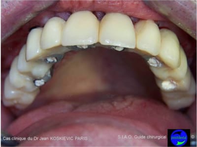 Guide chirurgical dentaire 04 qstru3 - Eugenol
