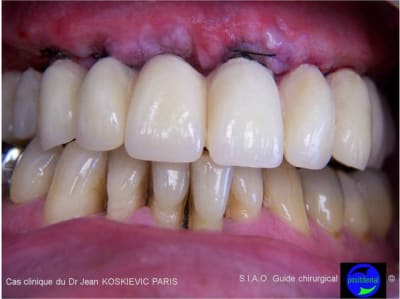 Guide chirurgical dentaire 05 ktmwr2 - Eugenol