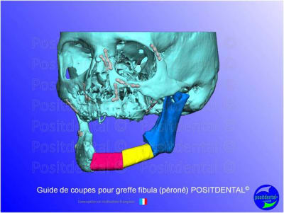 Guide de coupes pour greffe fibula  p ron   positdental 010 drlxie - Eugenol