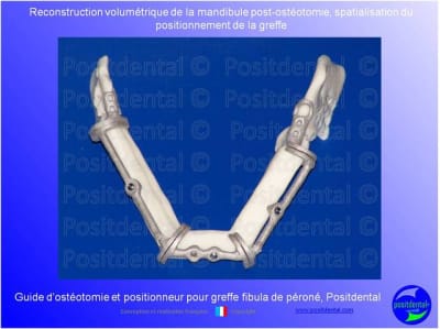 Guide de coupes pour greffe fibula  p ron    positdental 002 jpz2gh - Eugenol
