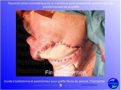 Guide de coupes pour greffe fibula  p ron    positdental 014 yqflhi - Eugenol