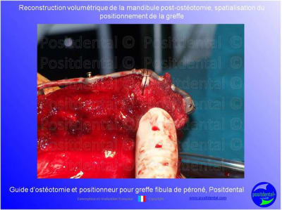 Guide de coupes pour greffe fibula  p ron    positdental 021 auytcd - Eugenol