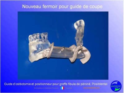 Guide de coupes pour greffe fibula  p ron    positdental 033 phbdin - Eugenol