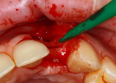 Img 2233r teeivp - Eugenol