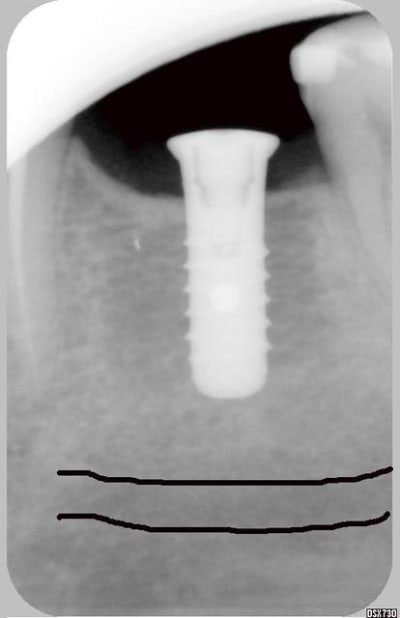 Implant1 phvodv - Eugenol